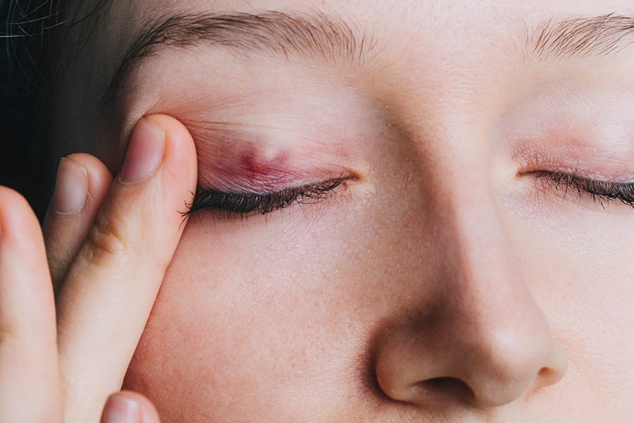 chalazion oeil traitement chirurgiens ophtalmologues specialistes paupieres paris centre ophtalmologique paris est