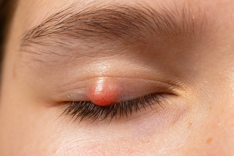 chalazion paupiere oeil ophtalmologue chirurgie refractive vision sante paris chalazion paupiere oeil ophtalmologue chirurgie refractive vision sante paris