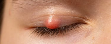 chalazion paupiere ophtalmologue chirurgie refractive vision sante paris